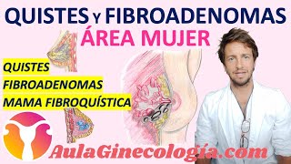 QUISTES Y FIBROADENOMAS de MAMA: Qué son y qué repercusiones tienen. - Ginecología y Obstetricia -