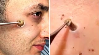 something got STUCK in his cheek..