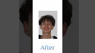 Braces transformation!