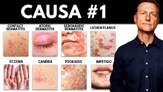 Dermatitis y otras enfermedades de la piel: el déficit que nadie está tratando