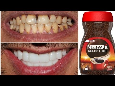 Transform your teeth from yellow to shiny white like pearls/ scaling at home in 1 minutes.