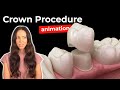 Dental Crown Procedures and Techniques