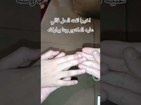 اخيرا لقت الحل قالي عليه الدكتور ربنا يباركله #اكسبلور #تيك_توك #ترند #فكروني #فكرتين #لايك #shorts