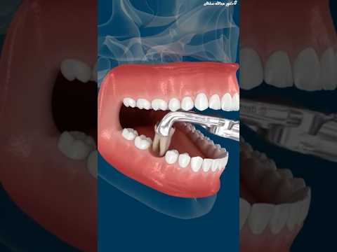 ماذا يحدث لأسنانك بعد خلع الضرس؟ الحقيقة التي لا يخبرك بها أحد! #دكتور_عبدالله_سلطان #اكسبلور
