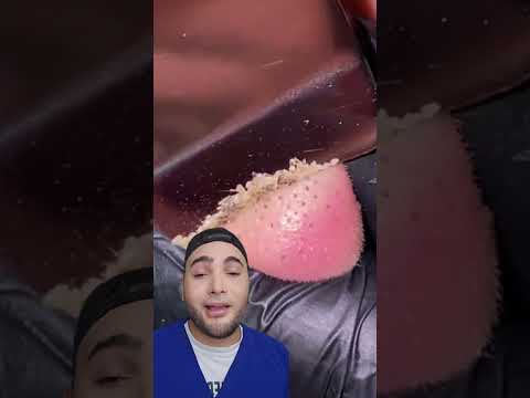 Puntos negros y filamentos sebáceos (video Inspiración de Helena Rodero Farmacéutica)