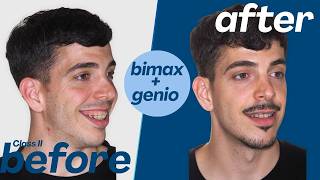 Sleeping Better After Orthognathic Surgery | Manuel's Experience