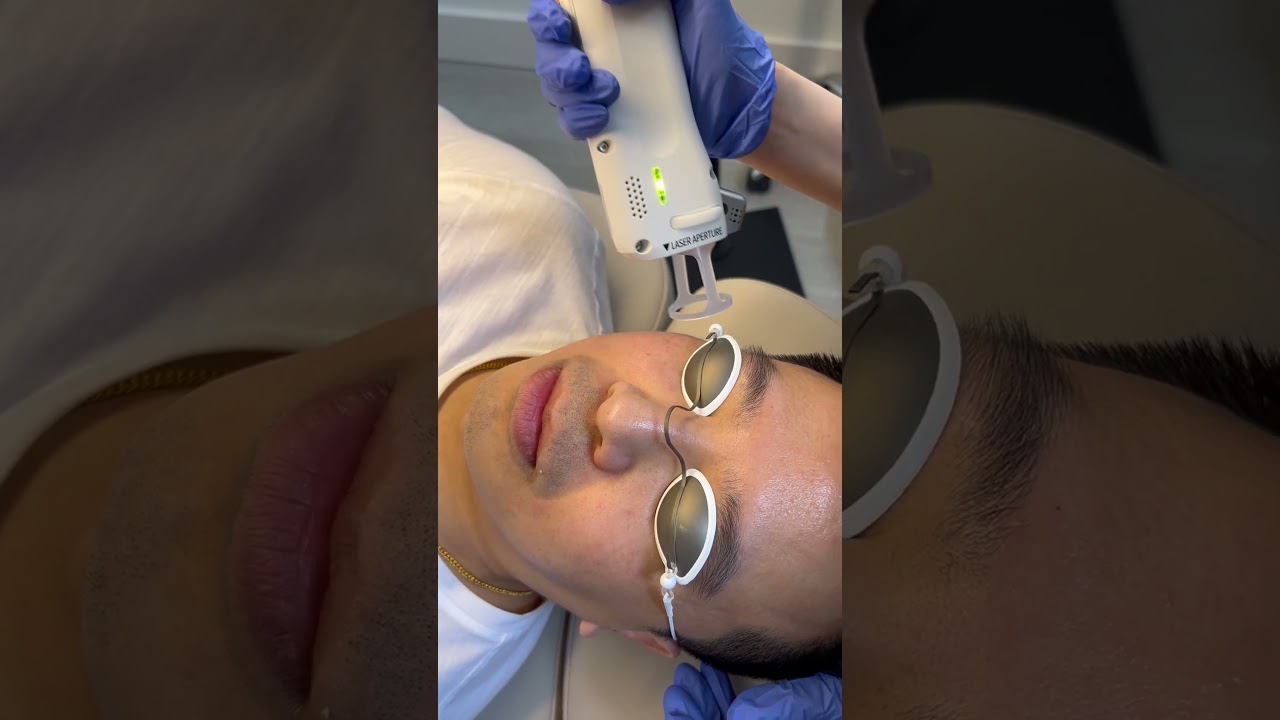 Laser treatment session for skincare rejuvenation.