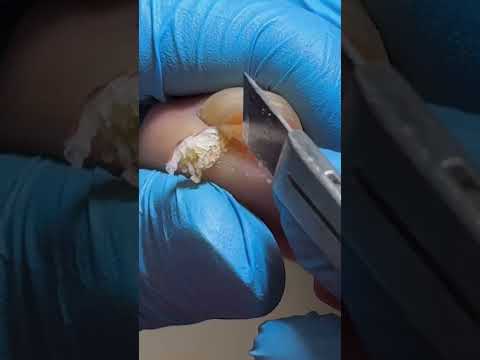Satisfying Pedicure Video! #pedicure #toenails