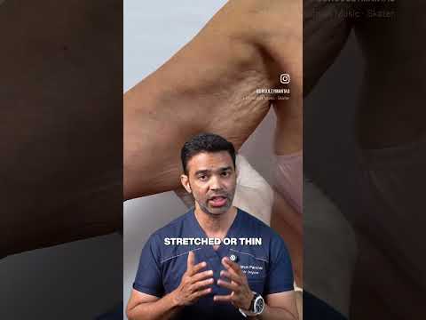 Why "Scarless" Arm Lift Might NOT Work for You | When You Need Traditional Brachioplasty