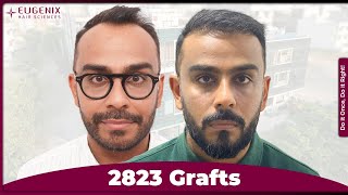 Hairline Reconstruction: A Client's Experience from Start to Finish!