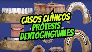 Casos Clínicos: Prótesis Dentogingivales