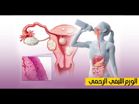 الاورام الليفية فى الرحم أعراضها وعلاقتها بتاخر الحمل و الاجهاض وعلاجها بدون جراحة