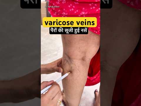 पैरों की नीली नसें (Varicose Veins) का आसान इलाज