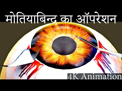 मोतियाबिंद का ऑपरेशन कराने से पहले ये जरूर देख ले। cataract surgery 3d animation.
