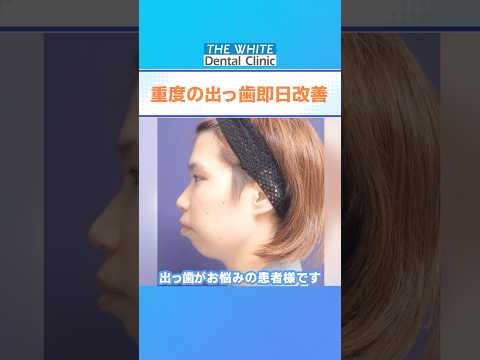 口ゴボ即日治療✨#ザホワイトデンタルクリニック #歯医者 #出っ歯 #口ゴボ
