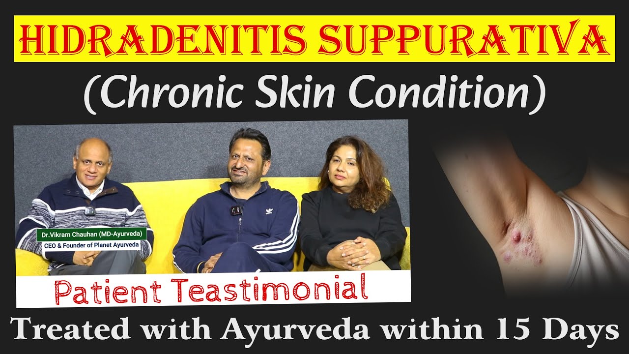 Watch Video Hidradenitis Suppurativa (Chronic Skin Condition) Treated with Ayurveda within 15 Days - Testimonial