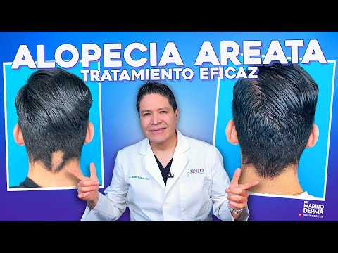 TRATAMIENTO EFICAZ PARA ALOPECIA AREATA