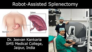 Robot-Assisted Splenectomy