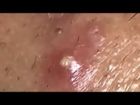 Blackheads & Whiteheads Satisfying Removal @0612