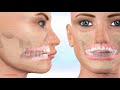 Understanding Open Bites and Oral Habits