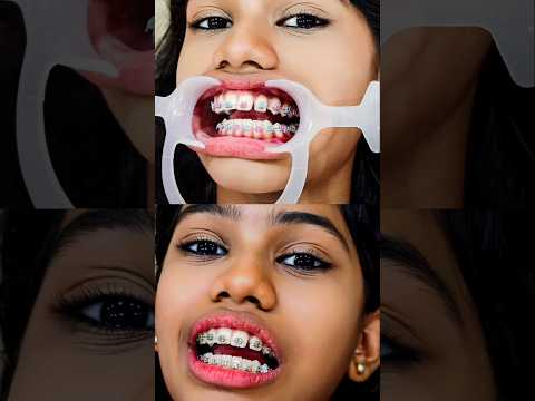 #Tiyakuttyയുടെ പല്ല് ആദ്യം ഇങ്ങനെയായിരുന്നു😁 ഇപ്പോൾ ഇതുപോലെയായി😱 വീണ്ടും #ColourChange