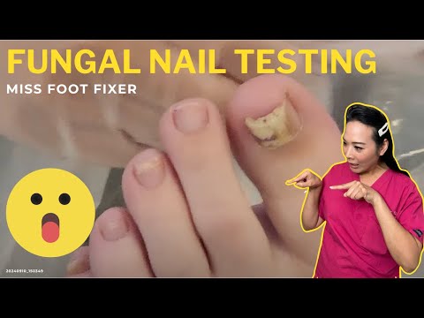 Fungal Nail Testing Process Explained | Diagnosis by a Pro