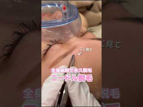 全身麻酔で効果抜群🥹❤️‍🔥 #全身麻酔 #脱毛 #ニードル脱毛 #無痛脱毛 #shorts