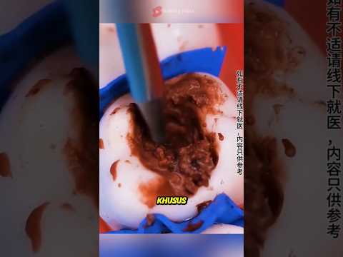 Saluran akar gigi rusak