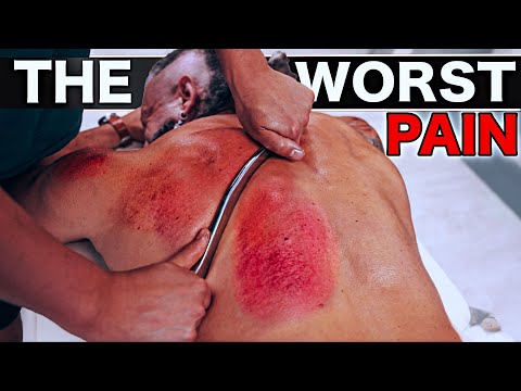 The WORST PAIN! Releasing TRAPPED BLOOD | Gua Sha Treatment for Back Pain!