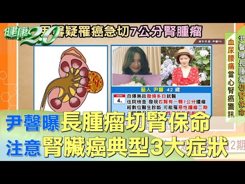 尹韾曝長腫瘤切腎保命 注意腎臟癌典型3大症狀 健康2.0