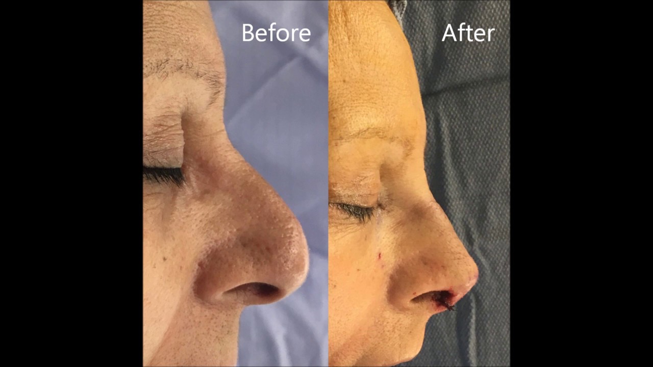 Before and after nose surgery comparison.