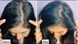 Try New L'Oréal Paris Hyaluron Pure Range For 3 Days Of Oil-Free Scalp & Hydrated Hair | JSuper Kaur