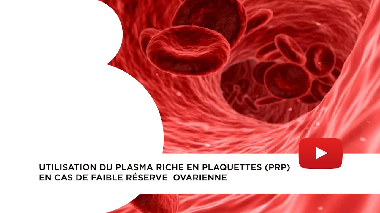 Utilisation du plasma riche en plaquettes (PRP) en cas de faible réserve ovarienne