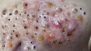Loan Nguyen Acne Treatment 119c