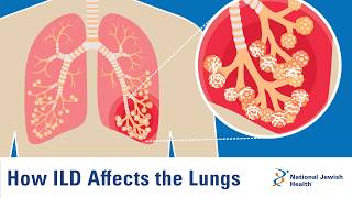 How ILD Affects the Lungs