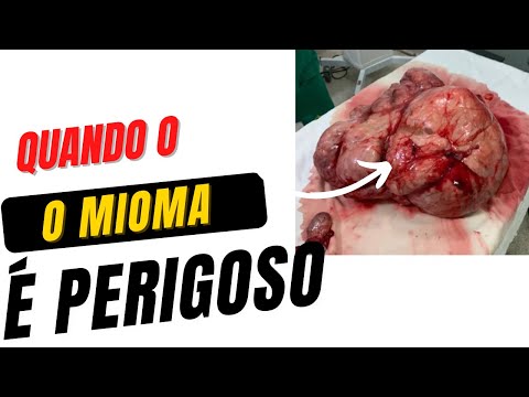 MIOMA NO ÚTERO: QUANDO SE PREOCUPAR?