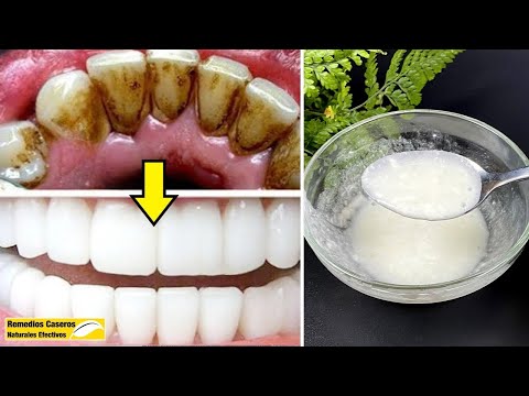 Receta Secreta Del Dentista: Elimina La Placa Dental Y El Sarro En 2 Minutos Con Esta Mezcla