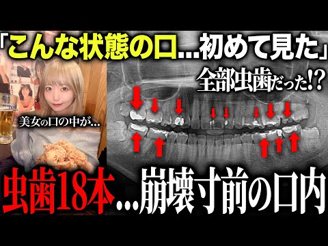 【衝撃】虫歯18本！？治療が怖くて途中で歯医者に通うのを辞めたグラドルの口の中が過去1やばかった