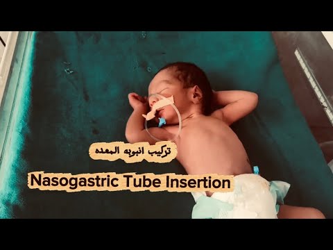 تركيب أنبوبة المعده || Nasogastric Tube Insertion (NG)