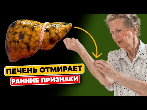 Вашей Печени Грозит Опасность: 6 ранних Признаков того, что ваша ПЕЧЕНЬ ОТМИРАЕТ