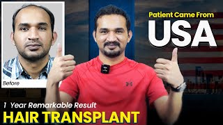 Amazing Hair Transplant Results | Hair Transplant Experience Before-After Transformation