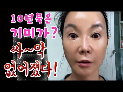 빨리 따라해보세요! 10년 묵은 기미도 싹 없어졌어요!