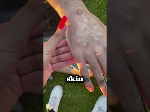 This Spider Will Crawl Under Skin! ?