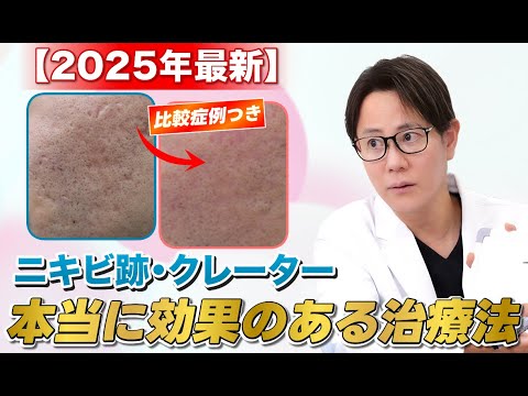【2025年最新】ニキビ跡｜これを見れば本当に効果のあるクレーター最新治療が分かります！
