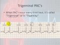 Atrial Complexes and Rhythm Interpretation