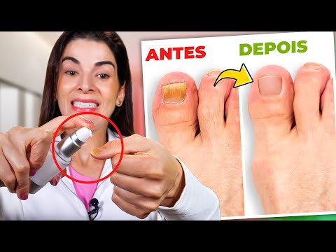 Receita para CURAR MICOSE DE UNHA e Acabar com os Fungos!