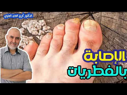 فطريات الأصابع التهاب الظفر الفطري   -  الدكتور كريم العابد العلوي  -