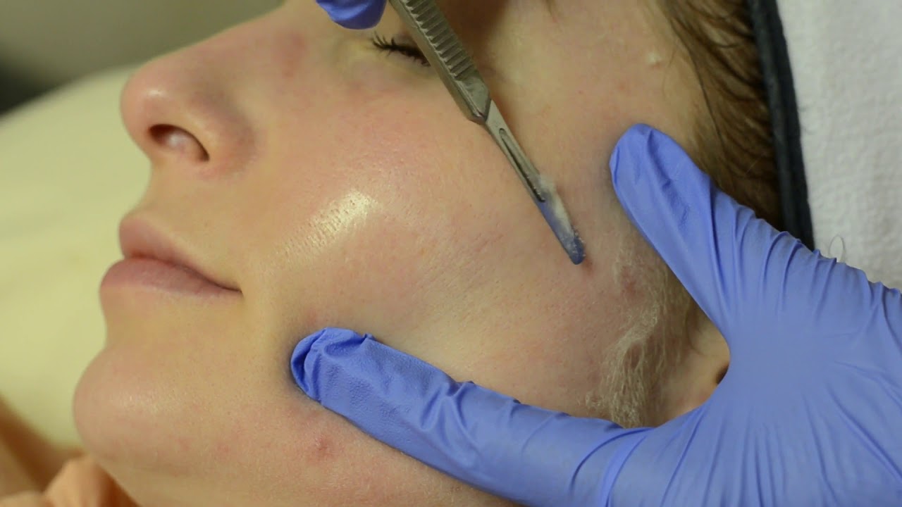 Woman receiving facial treatment with a scalpel.