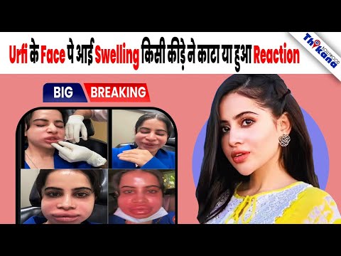 Shocking | किसने बिगाड़ा Urfi Javed का चेहरा, Face पे Swelling & फुले हुए होंठ पहचान ना हुआ मुश्किल