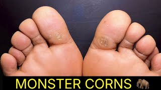 SHAVING TWO MONSTER CORNS!
